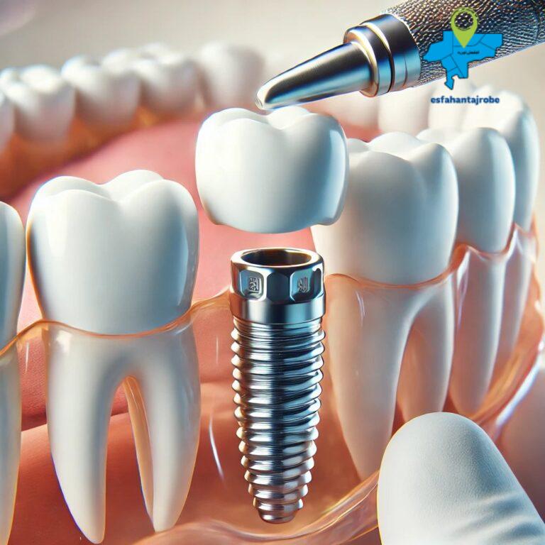 معرفی پزشکان ایمپلنت دندان در اصفهان با شرایط اقساط